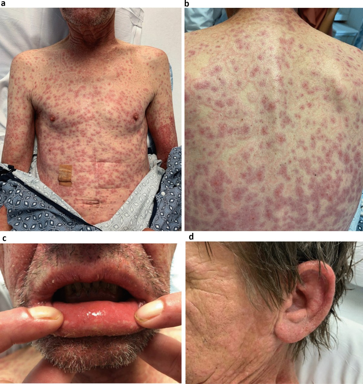 Updates and Insights in the Diagnosis and Management of DRESS Syndrome |  Current Dermatology Reports | Springer Nature Link