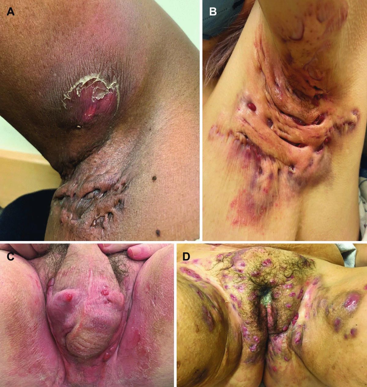 Strategies for Effective Management of Hidradenitis Suppurativa in the Hospital Setting | Current Dermatology Reports