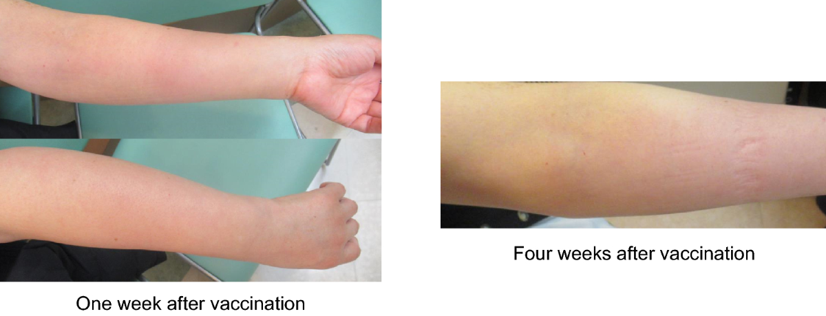 arm swelling after glutathione injection COVID arm that appeared in the contralateral upper extremity after  mRNA-1273 booster inoculation | International Cancer Conference Journal