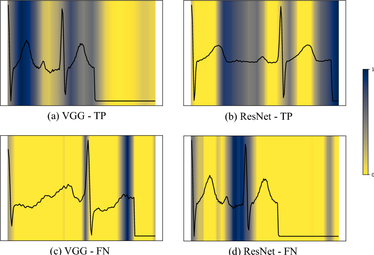 xECG-Beats: an explainable deep transfer learning approach for ECG-based  heartbeat classification | Network Modeling Analysis in Health Informatics  and Bioinformatics | Springer Nature Link
