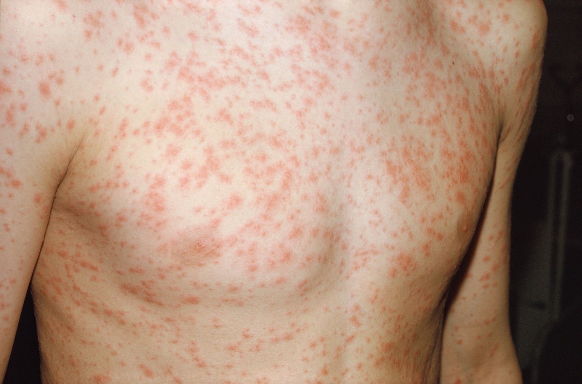 Infektise Exantheme | hautnah dermatologie | Springer Nature Link