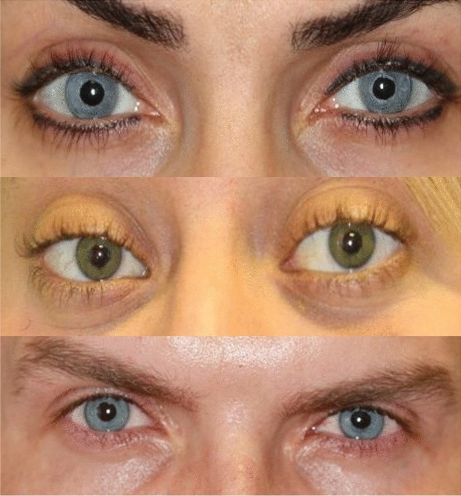 Eye color change surgery complication rates