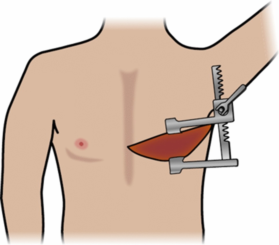 Emergency Department Thoracotomy in Trauma | Current Surgery Reports