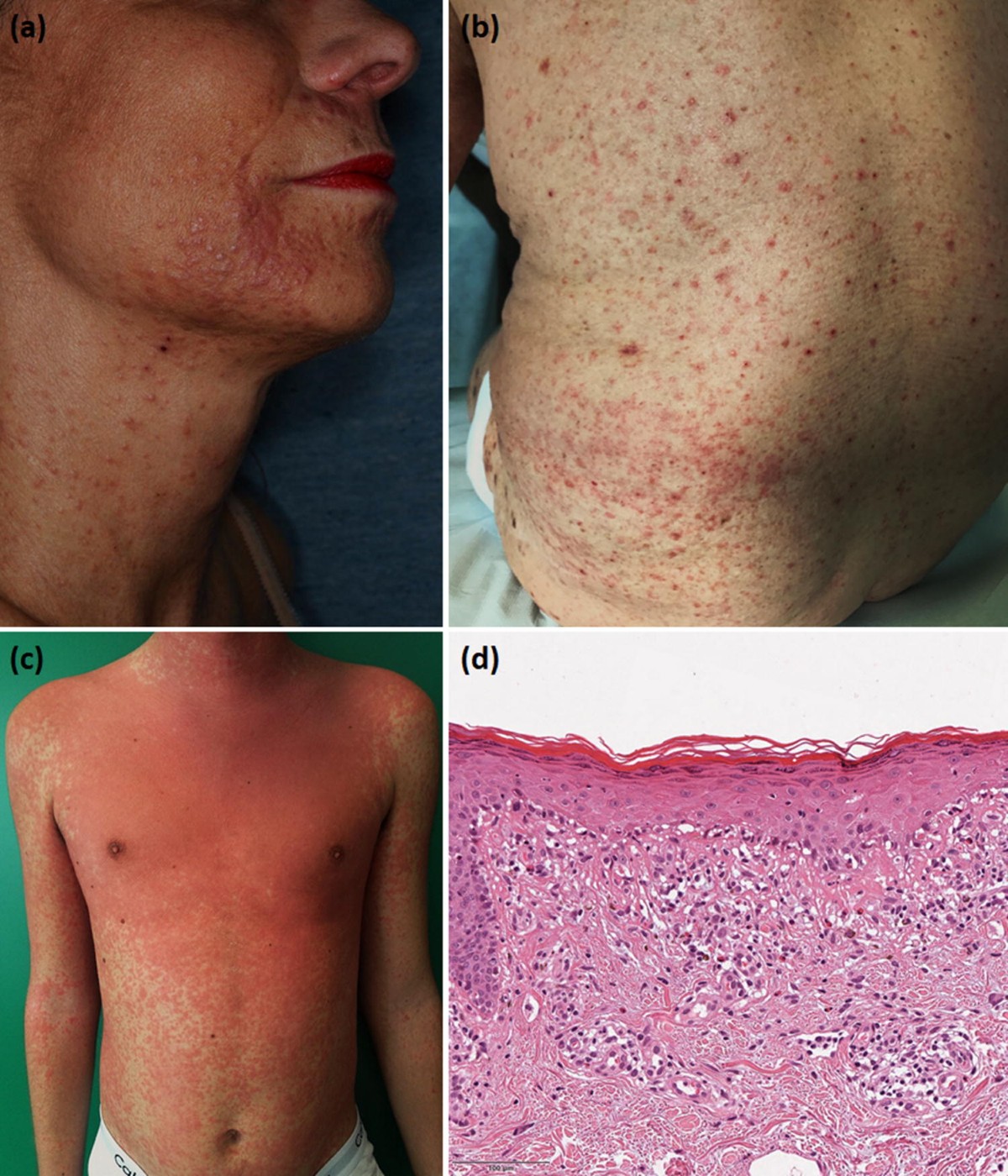 Eosinophilic cellulitis (Wells syndrome) successfully treated with  mepolizumab - JAAD Case Reports, image size:1200x1400