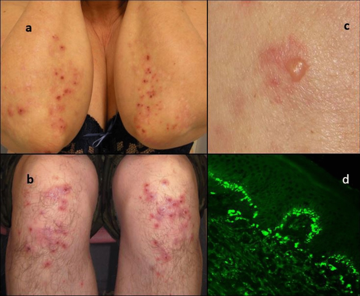 Dermatitis Herpetiformis (Celiac Disease Rash) Photos