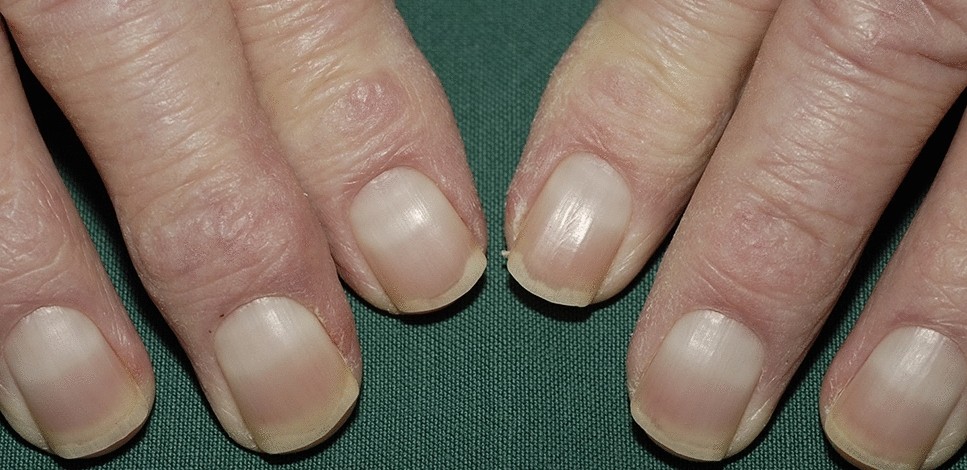Anyone ever had nails like this with celiac ? If so, did it go away? :  r/Celiac