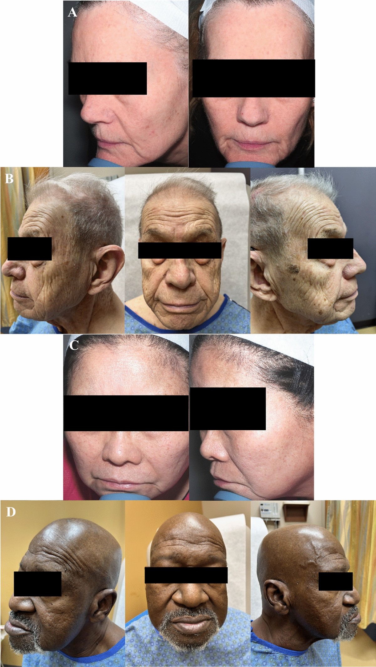 l glutathione moist whitening lotion asli dan palsu Cutaneous Aging in Skin of Color: A Narrative Review | American Journal of Clinical Dermatology GHK-Cu (Copper Peptide), Your monsoon-essentials Size:2 fl oz