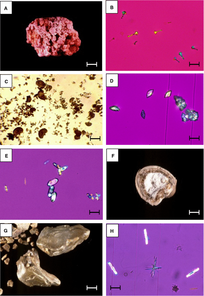 Drug-Induced Kidney Stones and Crystalline Nephropathy: Pathophysiology,  Prevention and Treatment | Drugs | Springer Nature Link