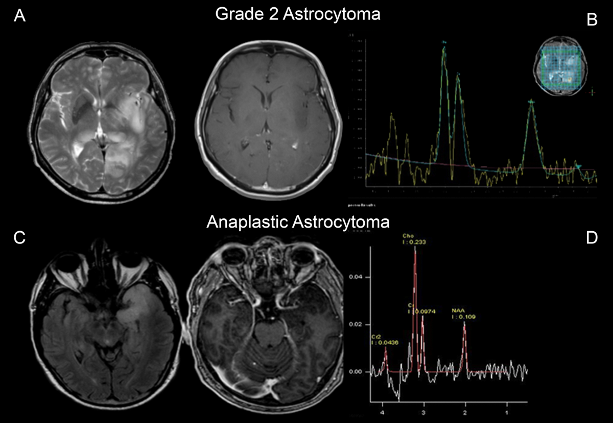 mri glutathione level tumor In vivo brain MR spectroscopy in gliomas: clinical and pre-clinical chances | Clinical and Translational Imaging Thinking about taking steroids tutti_meno_programmi Size:#120