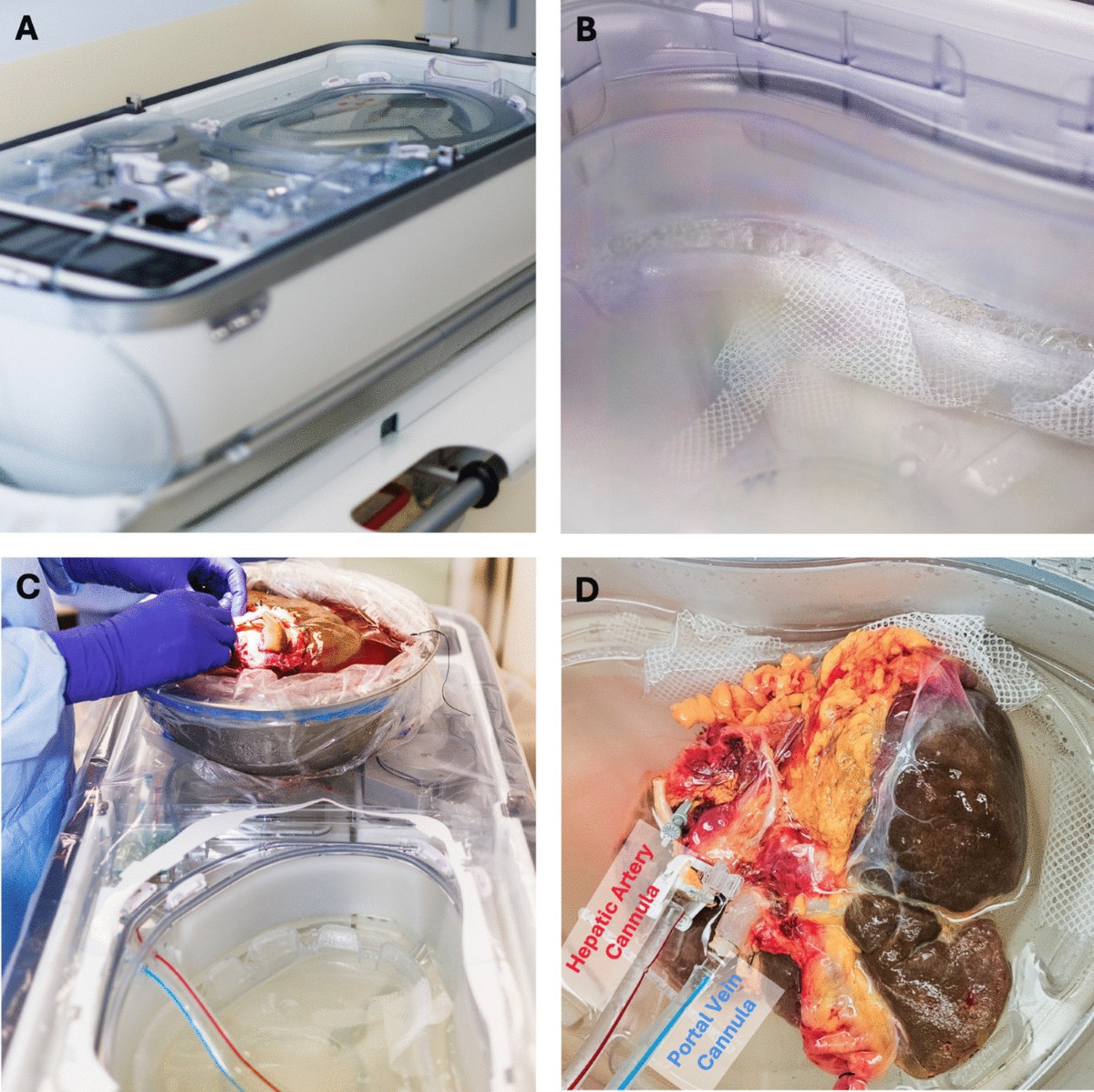 Hypothermic Machine Perfusion Of Liver Allografts: State Of The Art |  Current Transplantation Reports | Springer Nature Link