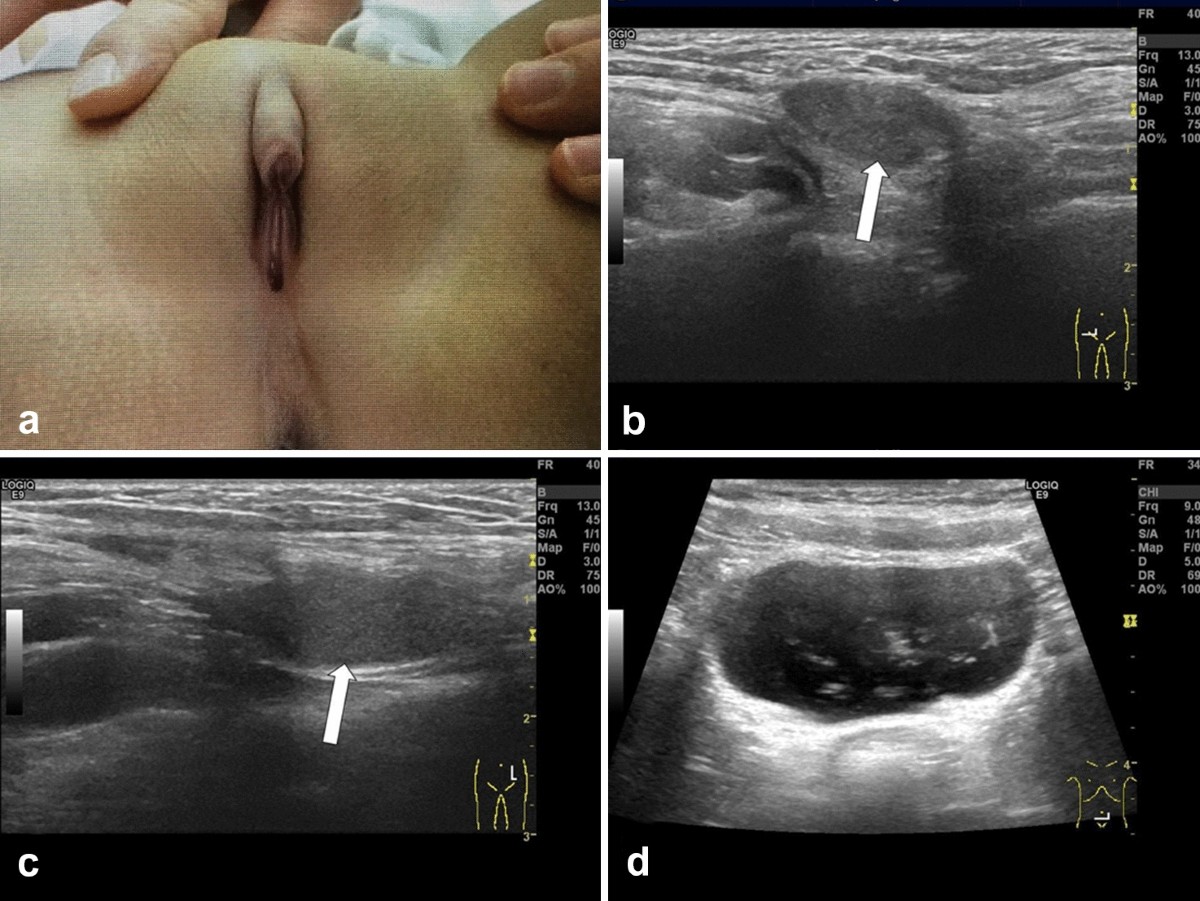 The role of ultrasound to evaluate the disorders of sex development: a  pictorial essay | Journal of Ultrasound
