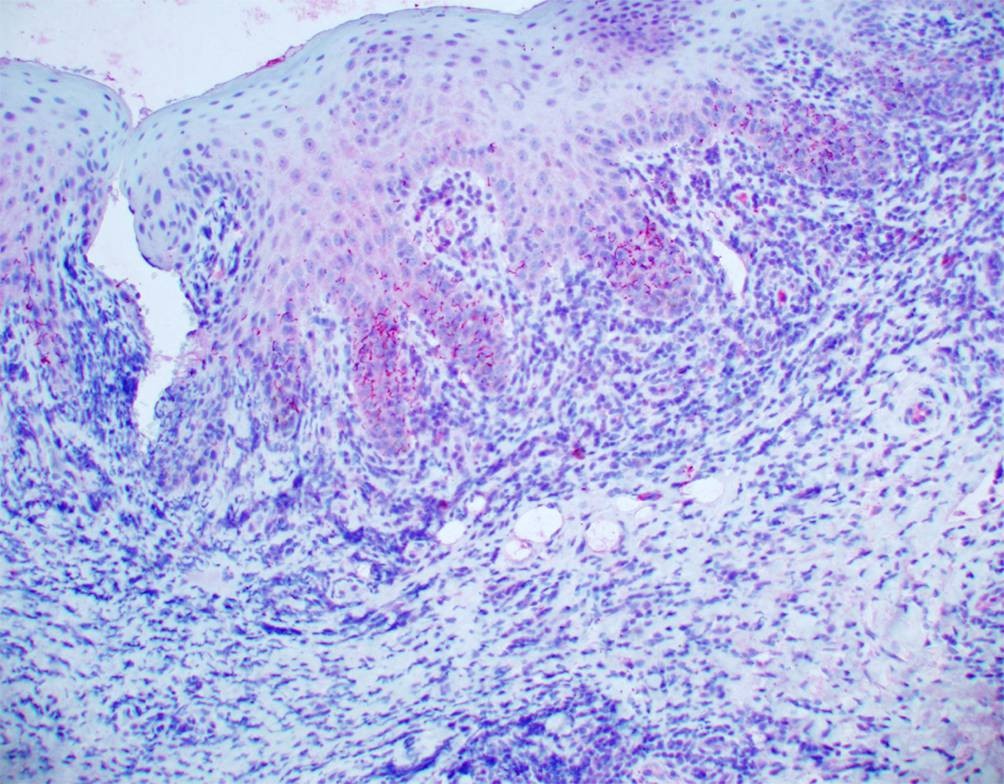 Syphilis | e.Curriculum Innere Medizin, image size:1004x784