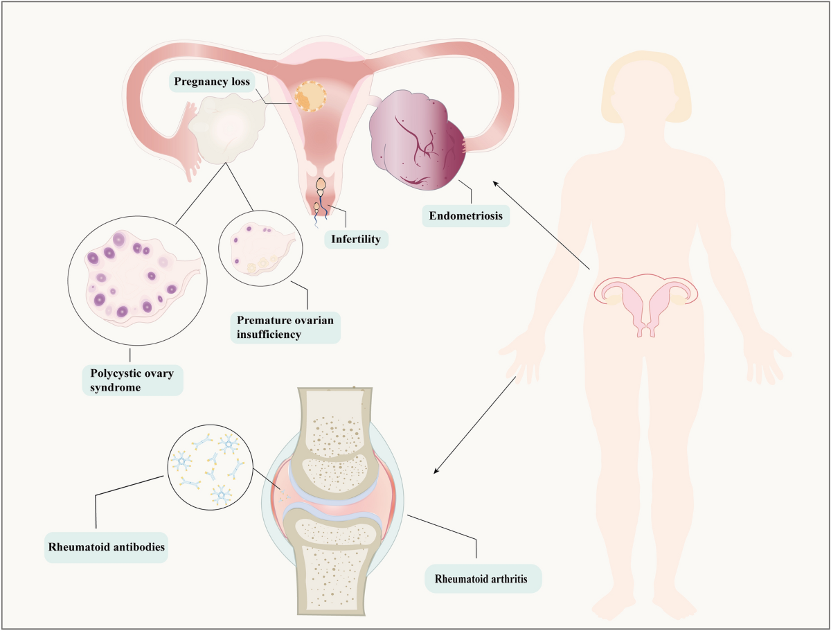 does glutathione help rheumatoid arthritis Reproductive Effect by Rheumatoid Arthritis and Related Autoantibodies |  Rheumatology and Therapy