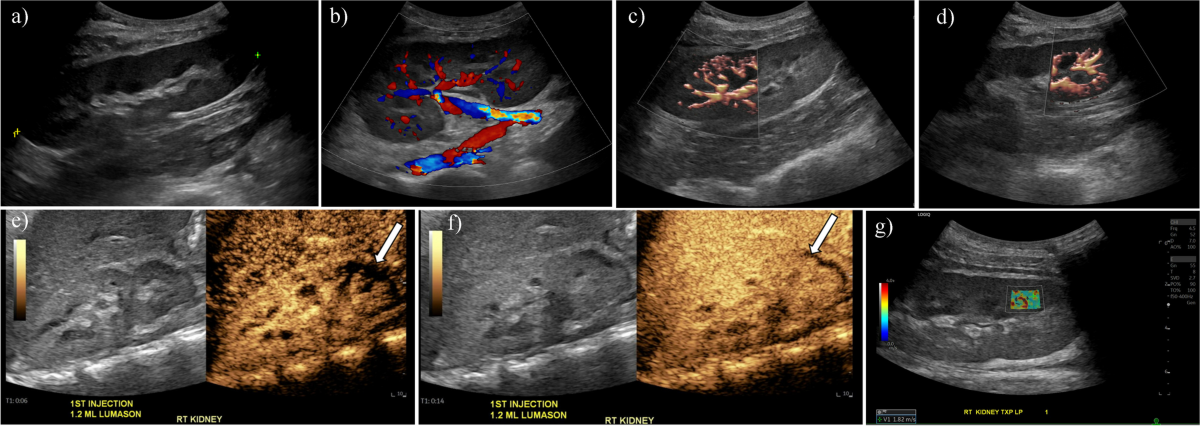 Renal Ultrasonography in Children: Principles and Emerging 