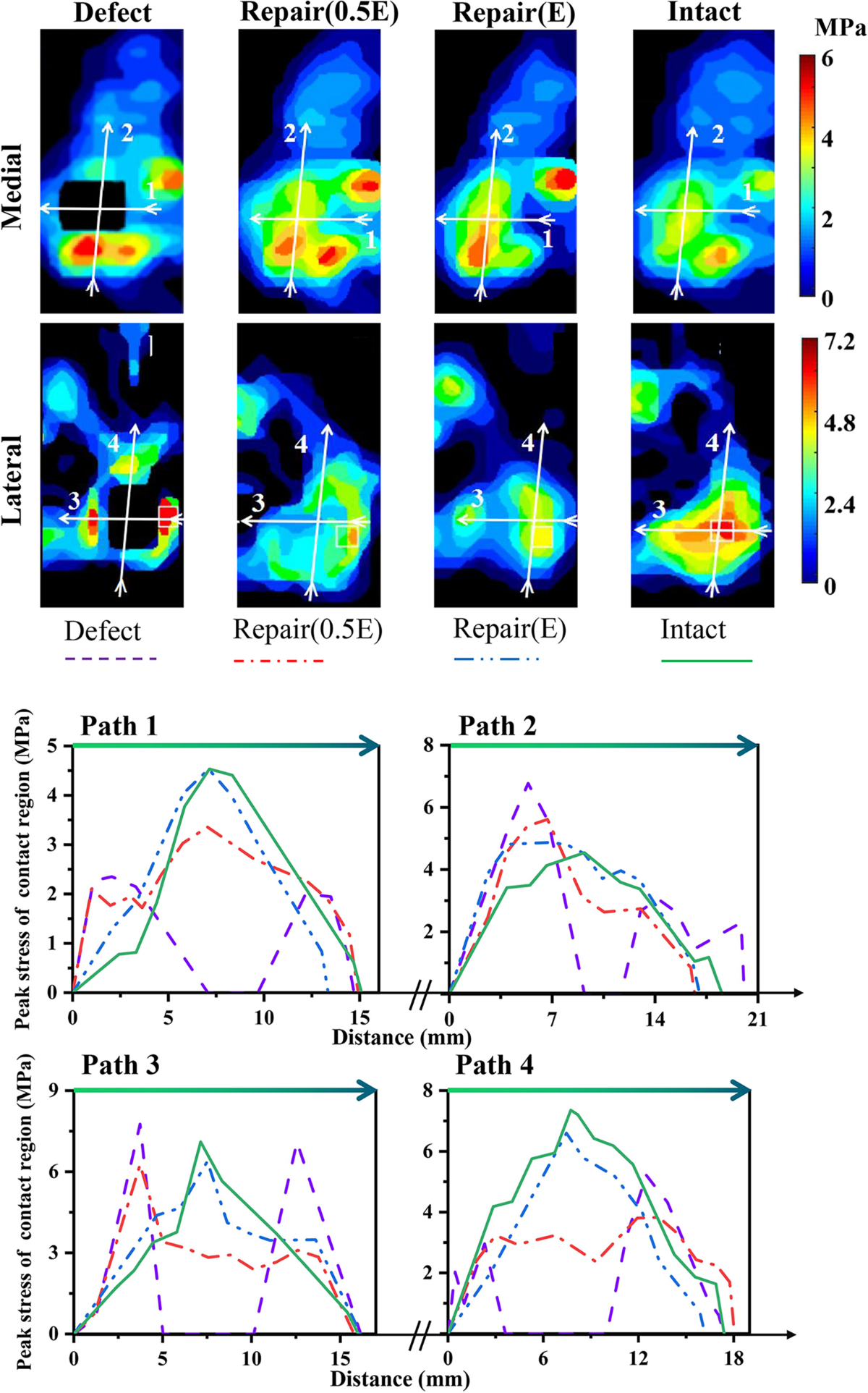 Stress Behaviors of Cartilage with Defect and After Repair in Total Knee  Under Compression Loading | Journal of Medical and Biological Engineering |  Springer Nature Link