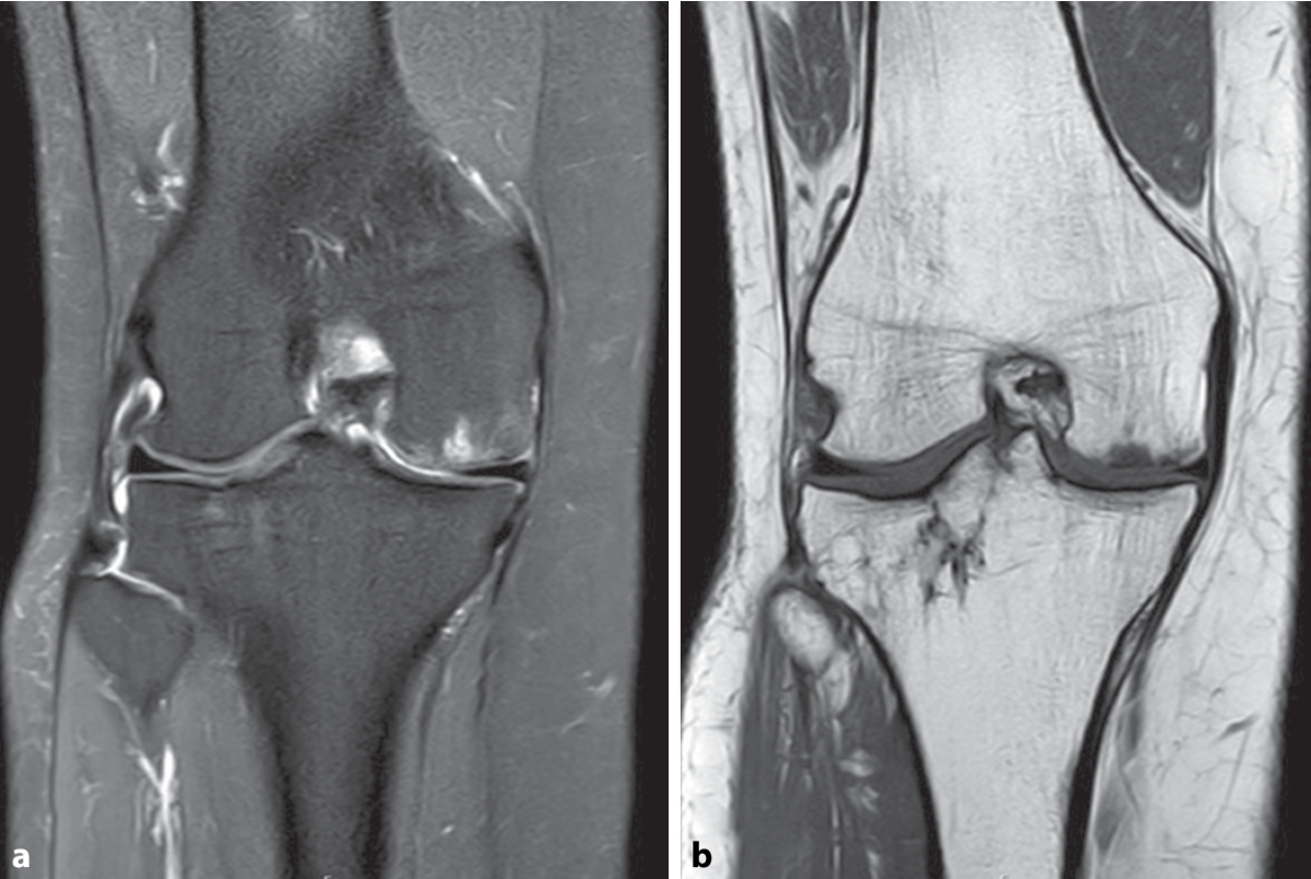 Diagnostik bei Knorpelschden des Kniegelenks: MRT und Umfelddiagnostik |  Knie Journal | Springer Nature Link