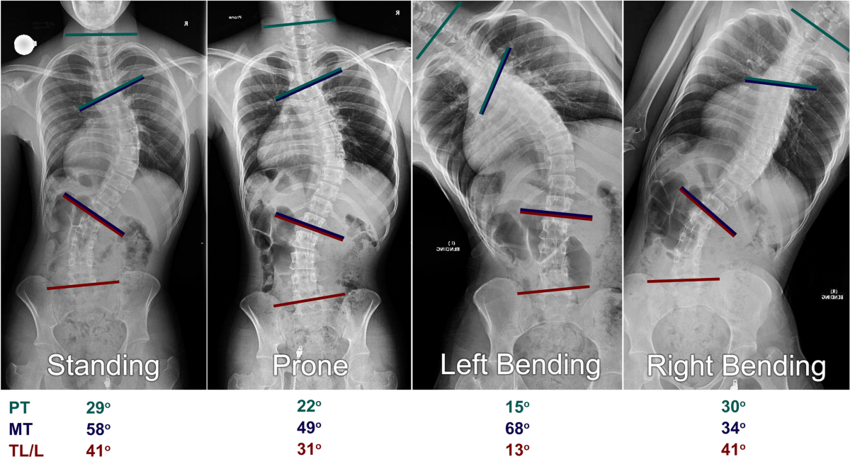 Pre-operative prone radiographs can reliably determine spinal curve  flexibility in adolescent idiopathic scoliosis (AIS) | Spine Deformity