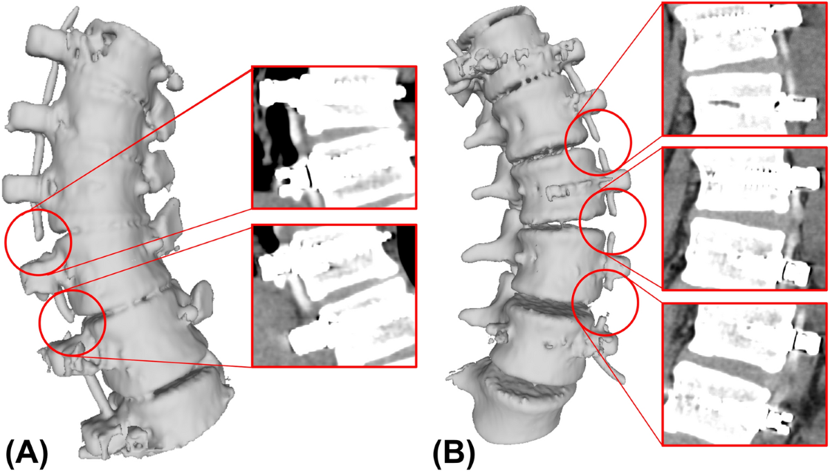 Inter-screw index as a novel diagnostic indicator of tether breakage |  Spine Deformity
