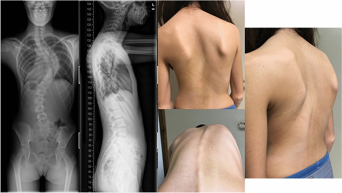 متى يُنصح بفحص القلب لدى مرضى اعوجاج العمود الفقري؟