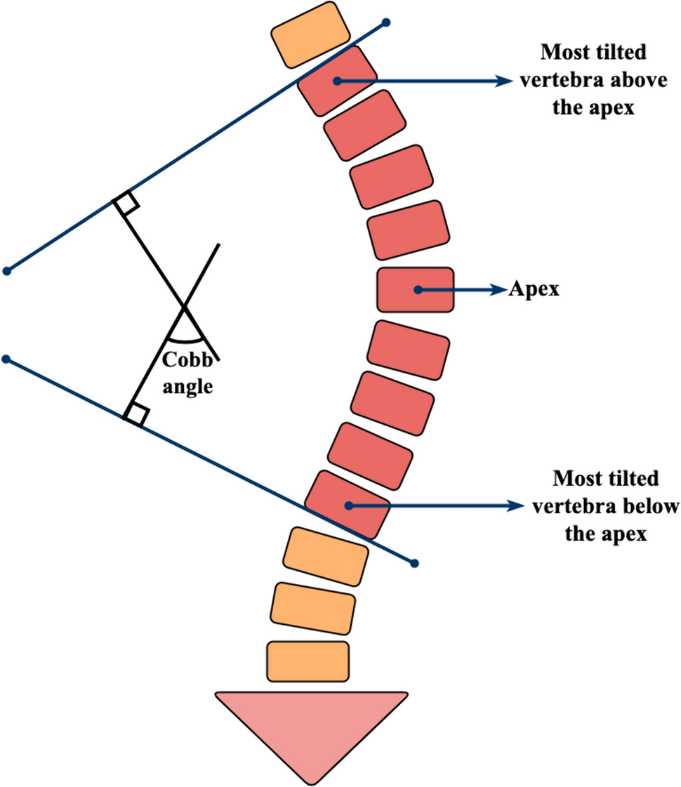 Deep learning in Cobb angle automated measurement on X-rays: a systematic review and meta-analysis | Spine Deformity
