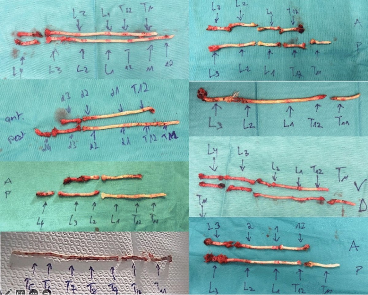Where does the tether break in vertebral body tethering cases? Clinical  insights from revision cases after tether breakage | Spine Deformity