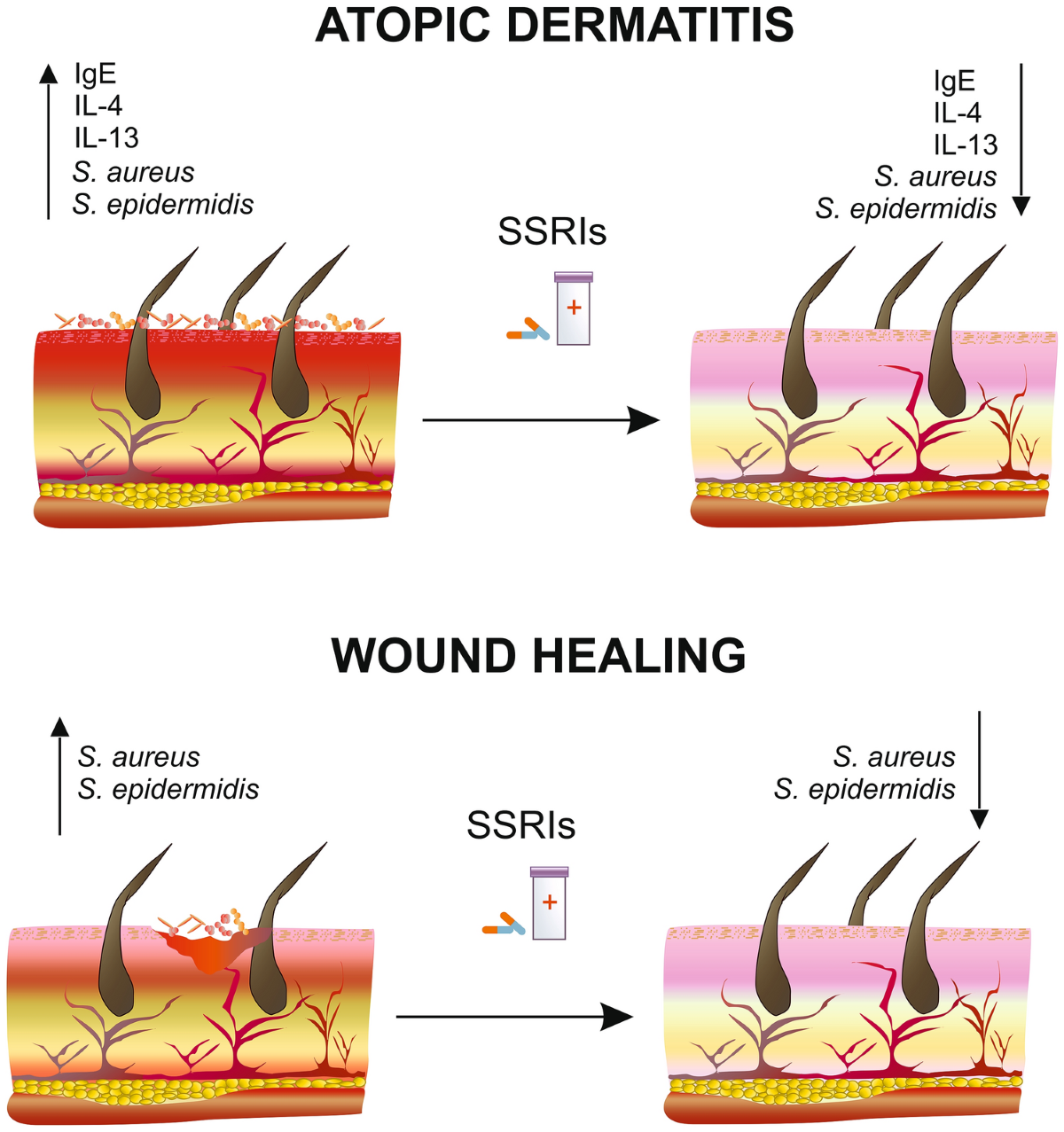 The potential action of SSRIs in the treatment of skin diseases including  atopic dermatitis and slow-healing wounds | Pharmacological Reports