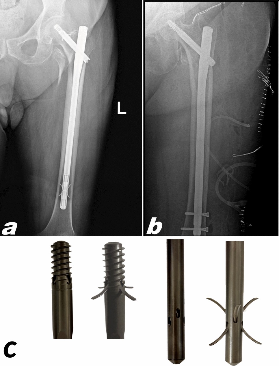Mechanistic Insights Into Lag Screw Cut-Out: The Impact of Distal Locking  Technique in Elderly Trochanteric Hip Fractures | Indian Journal of  Orthopaedics | Springer Nature Link