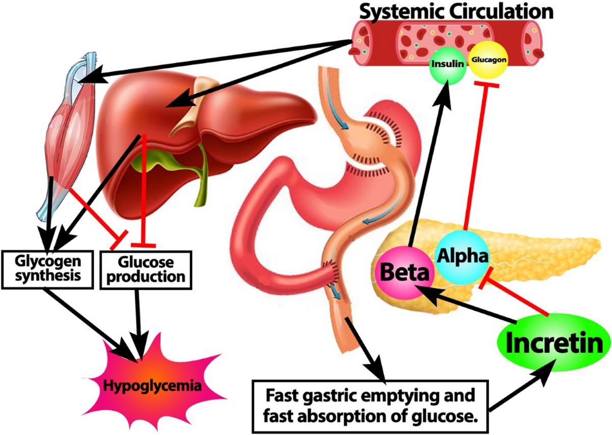 glp 1 reactive hypoglycemia Postprandial hypoglycemia following upper gastrointestinal tract surgery:  Pathophysiology, Diagnosis, and Management Strategies: a narrative review |  Discover Medicine