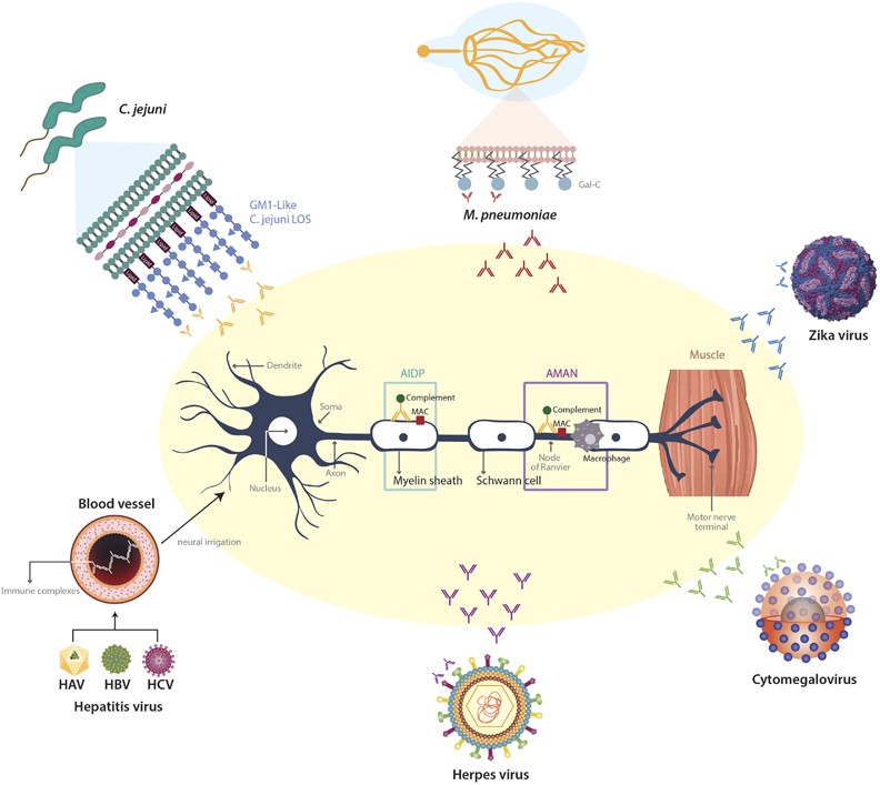 guillain barre syndrome and glutathione Guillain–Barré syndrome, transverse myelitis infectious diseases Health & Beauty Products