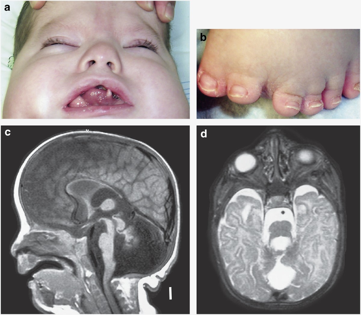 Exome sequencing identifies a mutation in OFD1 in a male with Joubert  syndrome, orofaciodigital spectrum anomalies and complex polydactyly |  Human Genome Variation