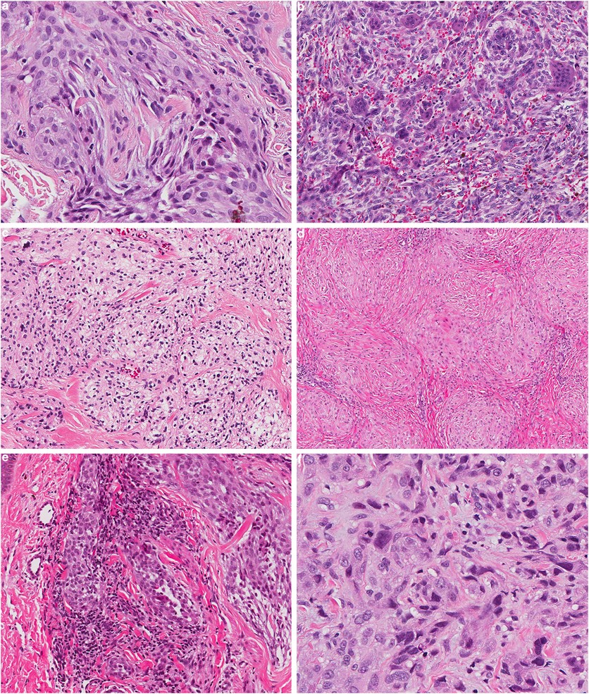 Frontiers | Case report: Cerebrotendinous xanthomatosis with a novel  mutation in the CYP27A1 gene mimicking behavioral variant frontotemporal  dementia, image size:836x985