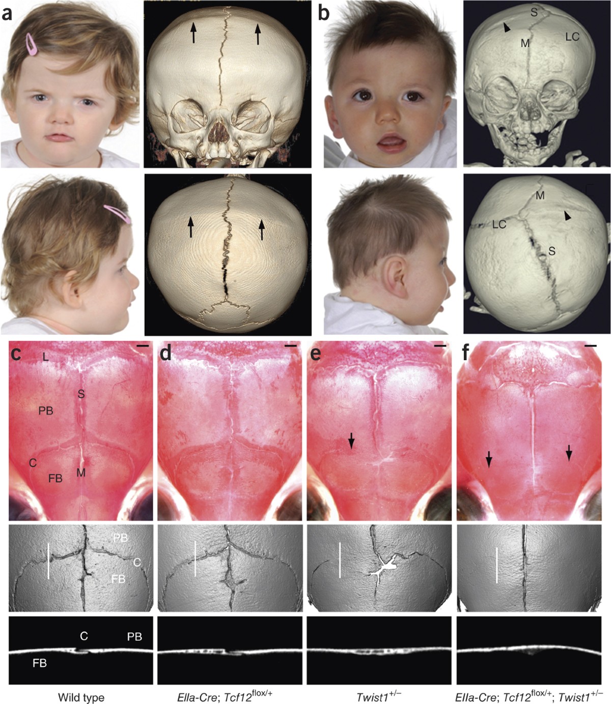 Mutations in TCF12, encoding a basic helix-loop-helix partner of TWIST1,  are a frequent cause of coronal craniosynostosis | Nature Genetics