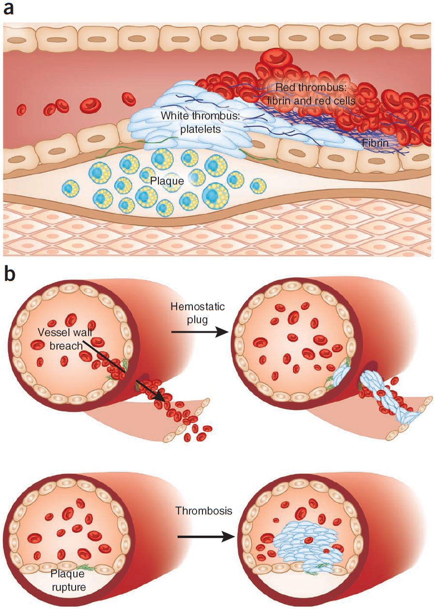 Arterial thrombosis—insidious, unpredictable and deadly