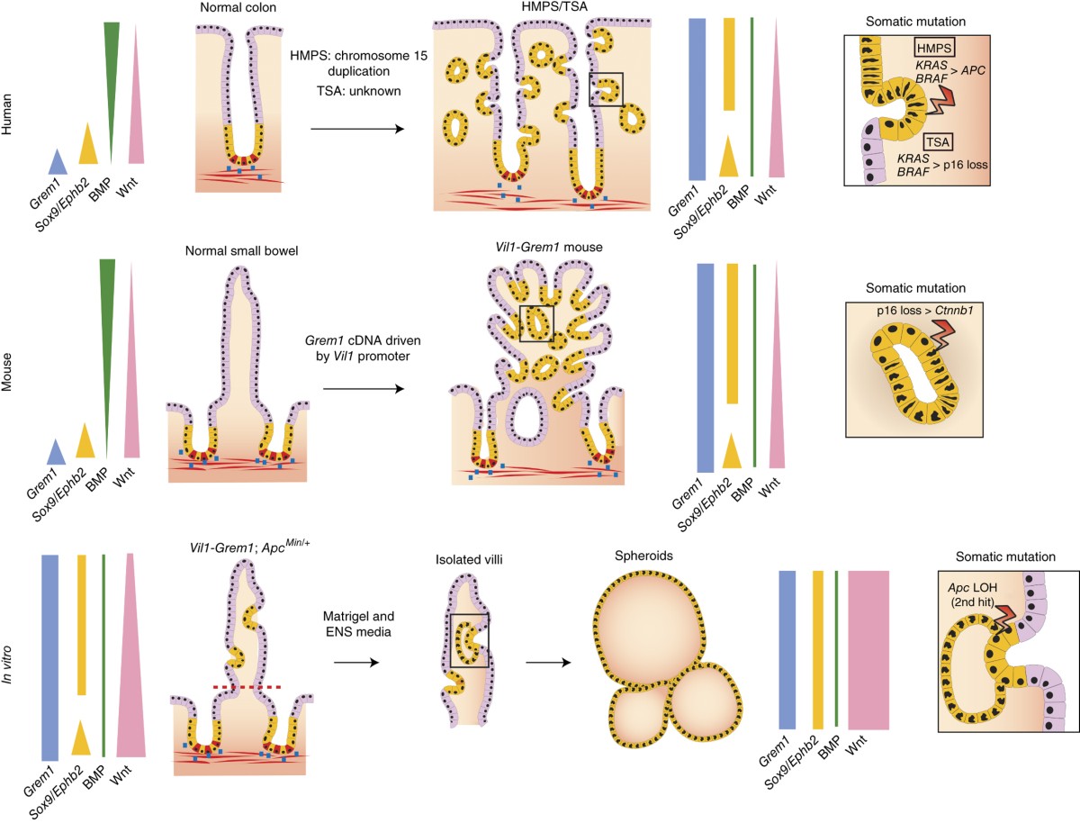 Aberrant epithelial GREM1 expression initiates colonic tumorigenesis from cells outside the stem cell niche | Nature Medicine (via www.nature.com)