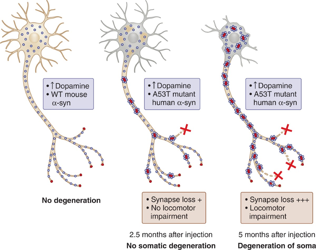 glutathion parkinson Synuclein and dopamine: the Bonnie and Clyde of Parkinson's disease Full article: A Novel Multi-Target
