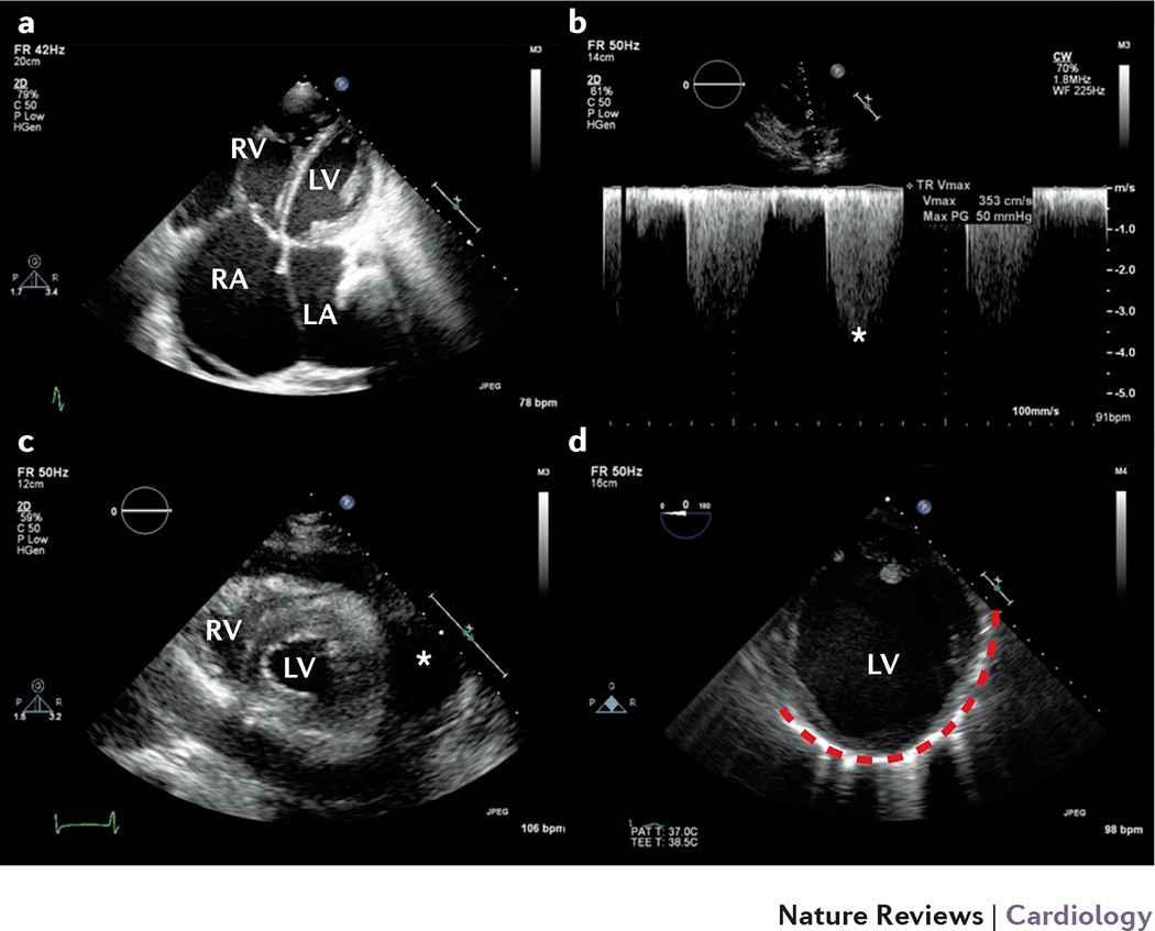 Echocardiography and lung ultrasonography for the assessment and management  of acute heart failure | Nature Reviews Cardiology