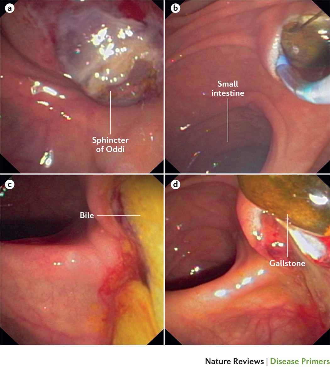 glutathione gallstones Gallstones