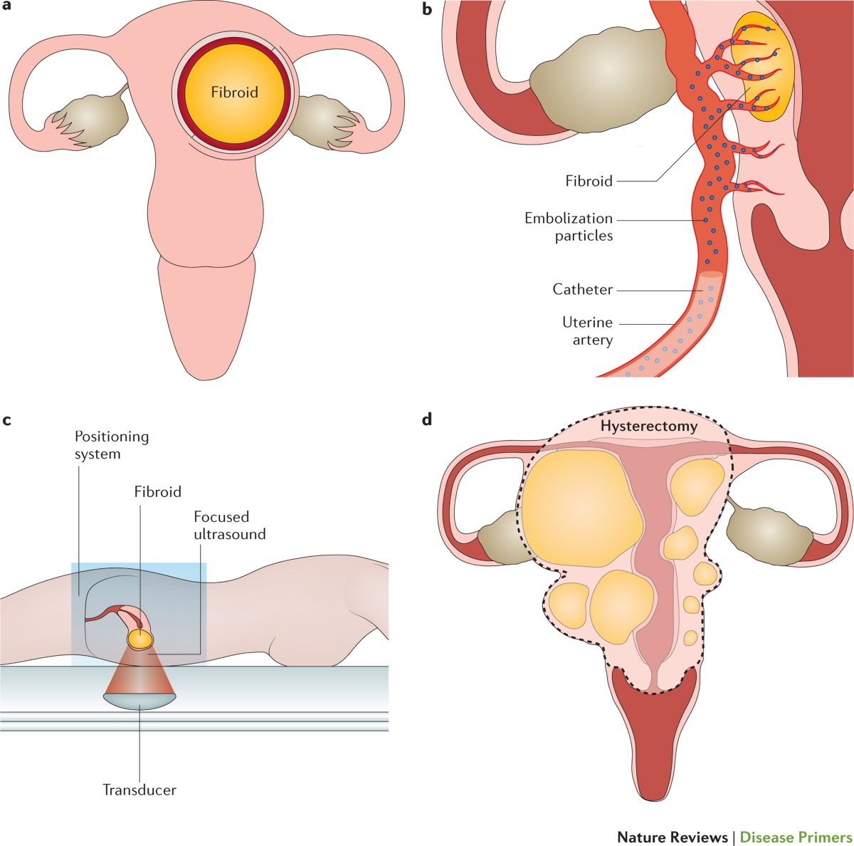 Uterine fibroids | Nature Reviews Disease Primers, image size:1200x1188