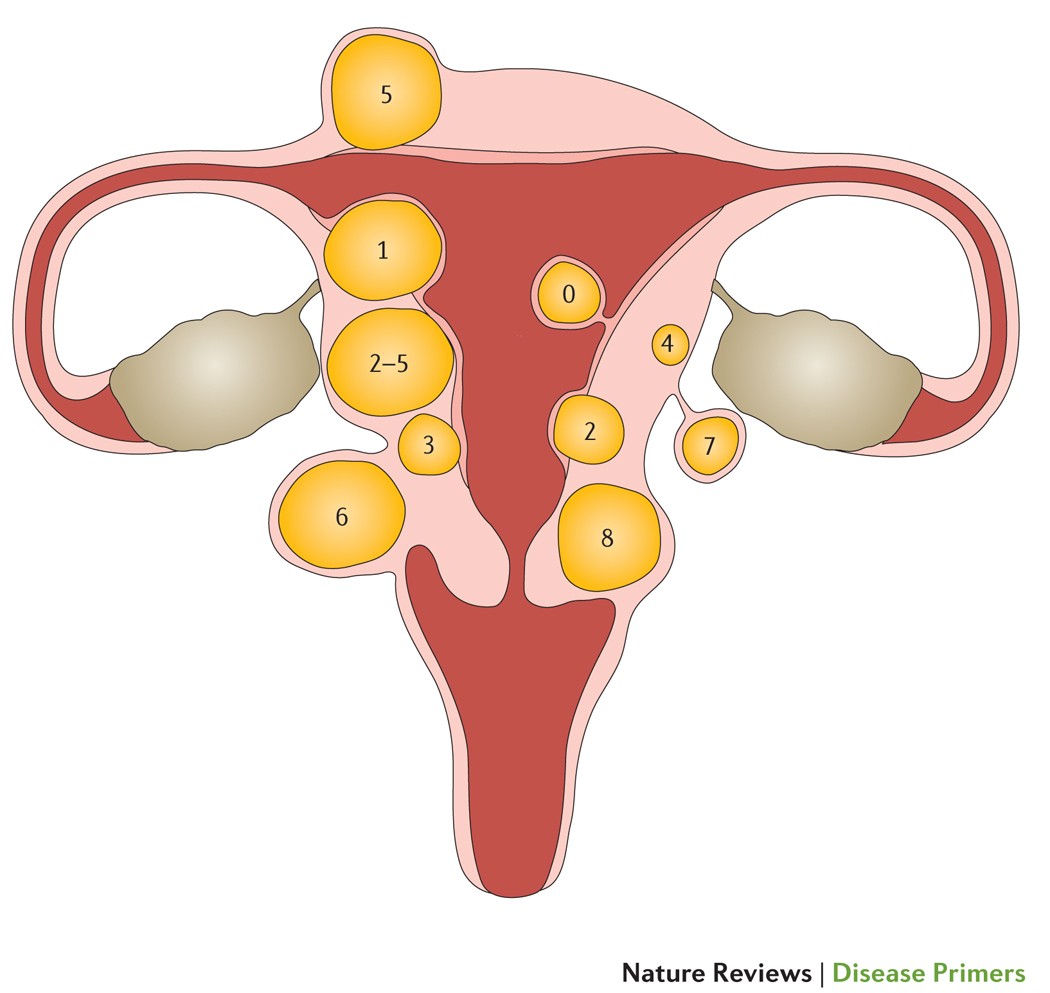 Uterine leiomyoma\u003c!-- --\u003e - \u003c!-- --\u003eKnowledge\u003c!-- --\u003e @ AMBOSS, image size:1050x993