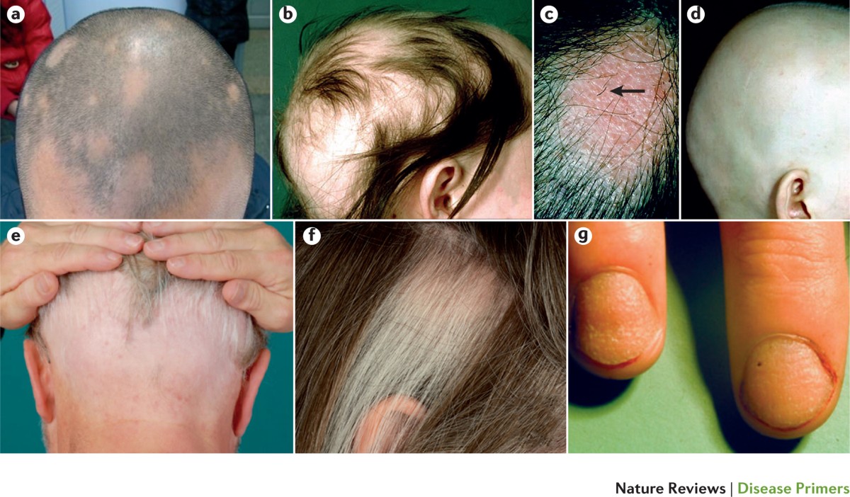 Alopecia Areata: What are the signs & Treatments available - iRESTORE Laser  – iRESTORE Hair Growth System