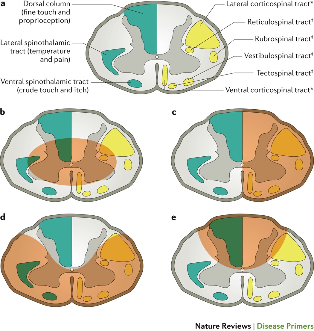 Traumatic spinal cord injury | Nature Reviews Disease Primers, image size:1050x1105