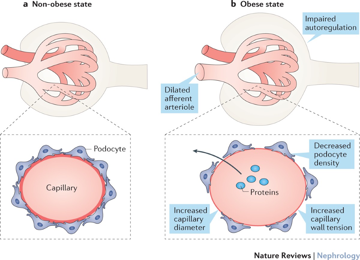 Kidney disease and obesity: epidemiology, mechanisms and treatment