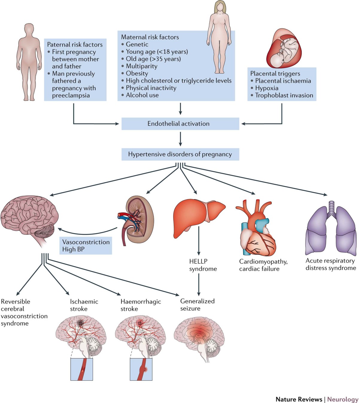 Stroke in women — from evidence to inequalities | Nature Reviews Neurology