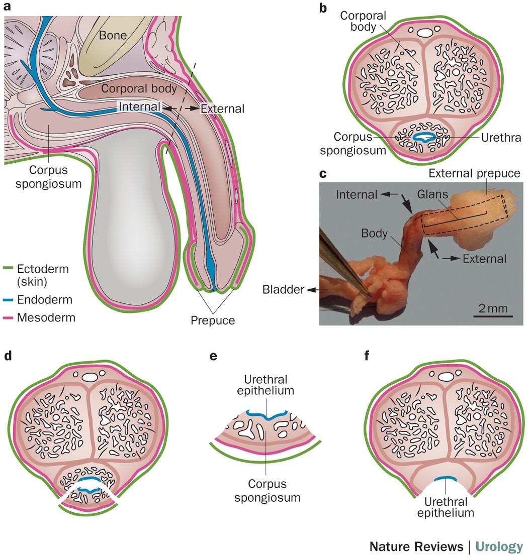 Hypospadias - Urologic Clinics, image size:1050x1111