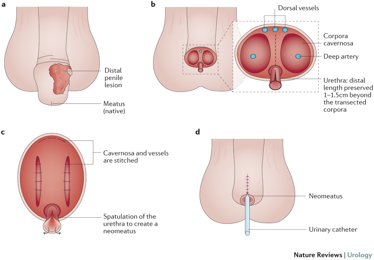 after penectomy 