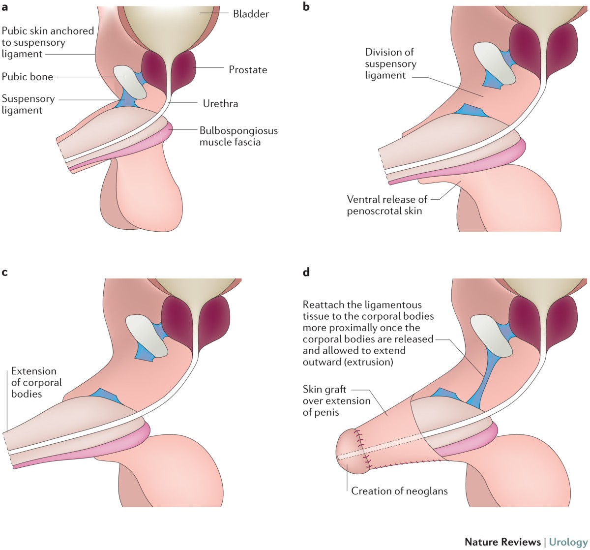 after penectomy Urologist