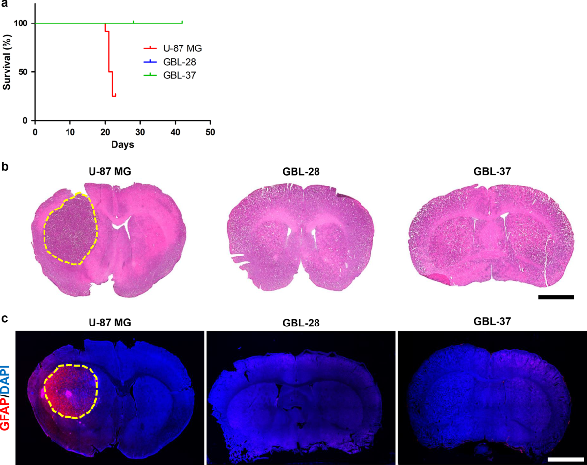 glutathione gbm6 patient derived xenograft Development of a patient-derived model of glioblastoma via intravitreal injection in mice Protocol for derivation of organoids