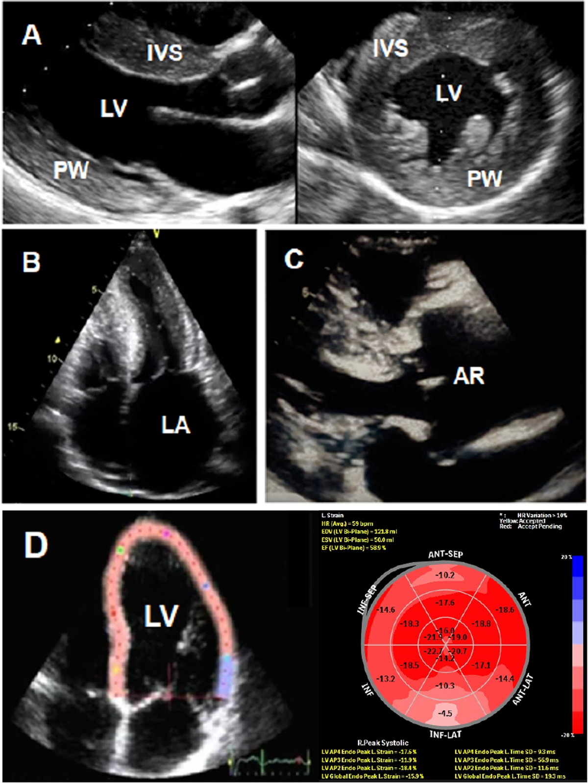 Sex, gender, and subclinical hypertensiveorgan damage—heart | Journal of  Human Hypertension