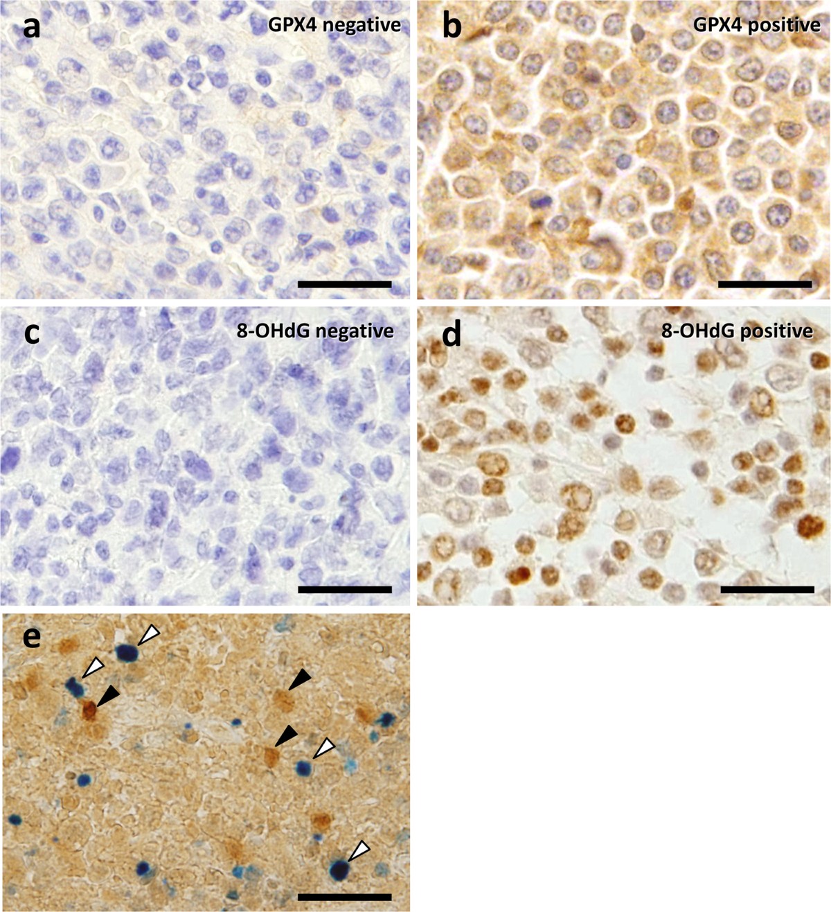 Glutathione peroxidase 4 overexpression inhibits ROS-induced cell death in diffuse large B-cell lymphoma