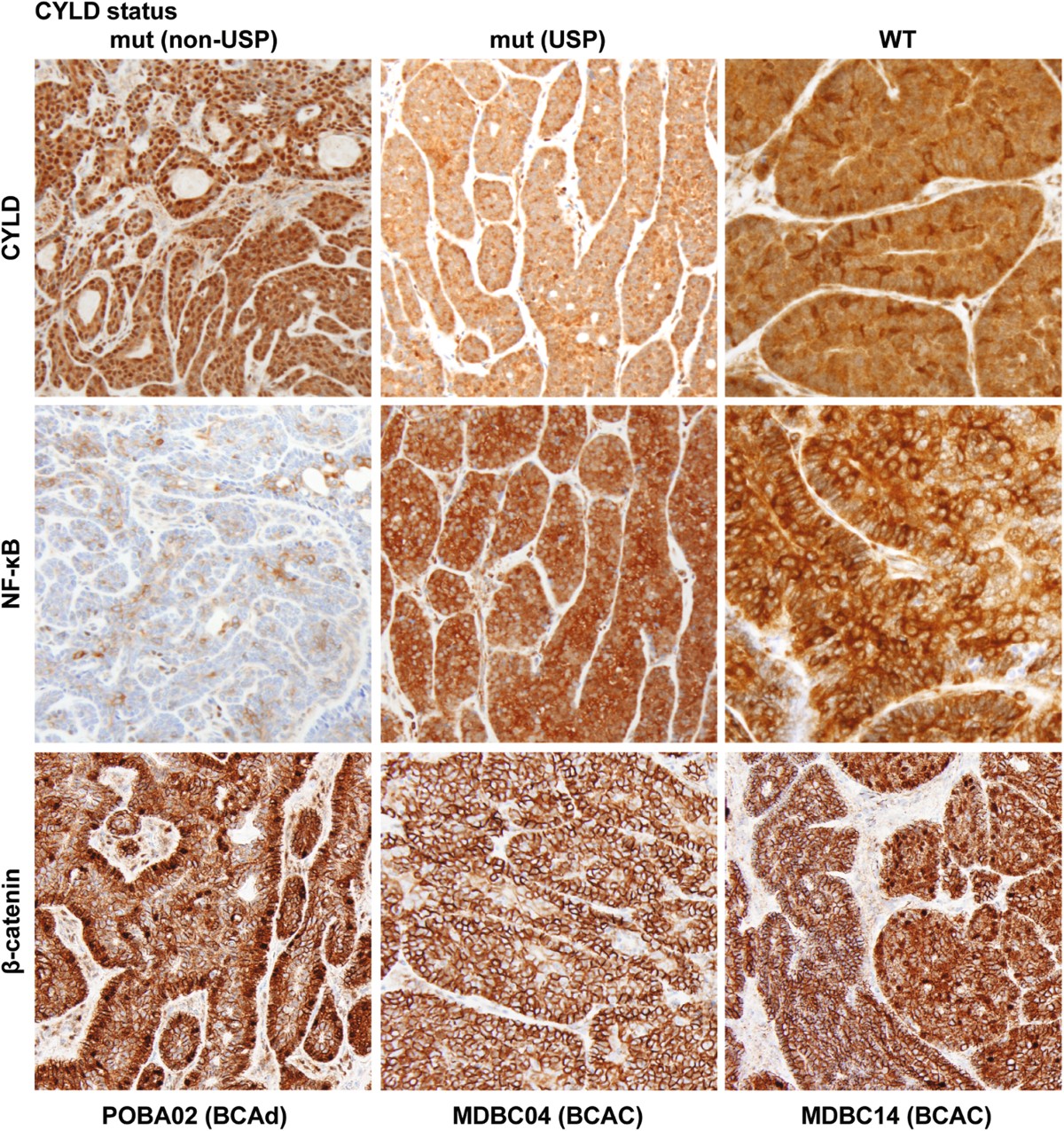 Frequent and differential mutations of the CYLD gene in basal cell salivary  neoplasms: linkage to tumor development and progression | Modern Pathology